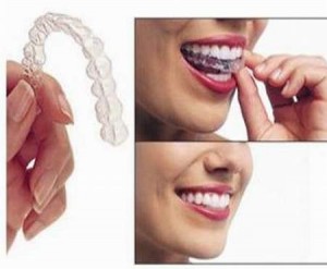 Khí cụ duy trì hàm răng sau khi tháo mắc cài