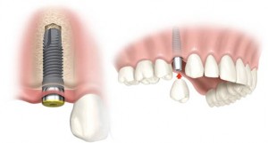 Tiêu chí lựa chọn địa chỉ trồng răng implant ở đâu tốt 1