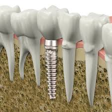 Mất răng - Có nên lựa chọn trồng răng implant?