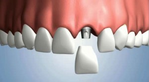 Mất răng - Có nên lựa chọn trồng răng implant ?