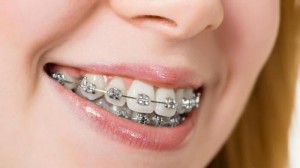 Người trưởng thành niềng răng hô có hiệu quả không?
