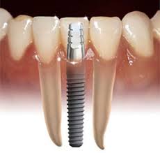Những hạn chế của phương pháp trồng răng implant