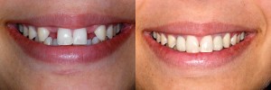 Những hạn chế của phương pháp trồng răng implant