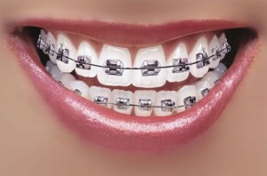 Niềng răng giá rẻ cho người lớn