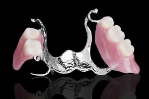 Sự khác biệt giữa phục hình răng truyền thống và implant