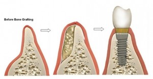 Xương hàm bị tiêu có trồng răng giả được không ?