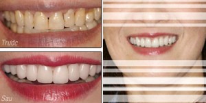 Bọc răng sứ toàn hàm có nguy hiểm không? 1