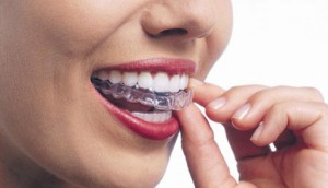Cách giữ gìn hàm răng sau khi tháo mắc cài