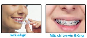 Cách giữ gìn hàm răng sau khi tháo mắc cài