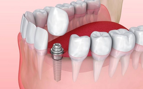Cắm ghép răng implant thay thế răng sâu nặng được không? 1
