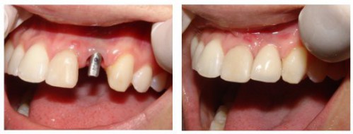 Cắm răng implant thay thế răng sâu nặng được không? 2