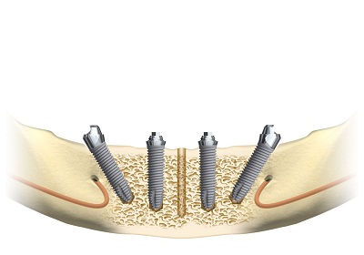 Cấy ghép implant cho trường hợp mất toàn bộ răng