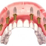 Implant nâng đỡ cầu răng khi mất răng toàn hàm