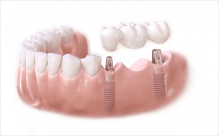 Cấy ghép răng Implant có tốt không? 2