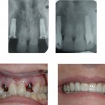 Tính chi phí cho một ca trồng răng implant