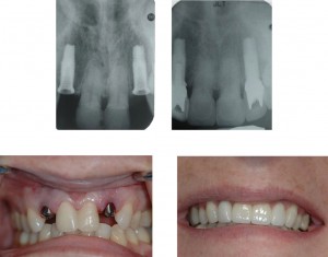 Tính chi phí cho một ca trồng răng implant