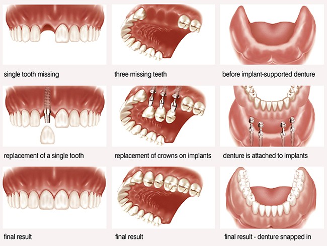 Cấy ghép răng Implant là gì? 2