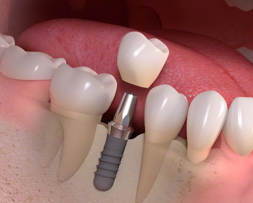 Implant răng hàm - Giải pháp phục hình răng tối ưu nhất 1