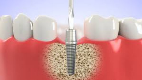 Kỹ thuật trồng răng implant 2