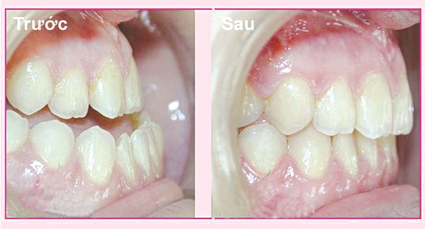 Quy trình niềng răng móm 1