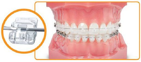 Niềng răng thưa - Phương pháp an toàn hiệu quả 3