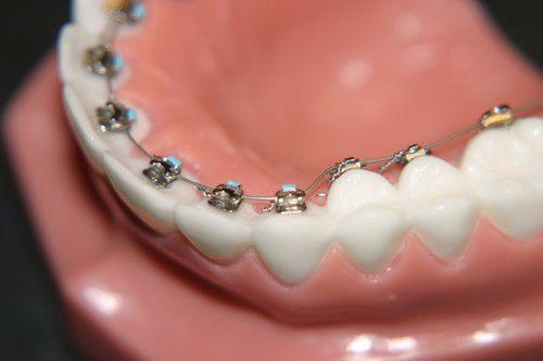 Niềng răng thưa - Phương pháp an toàn hiệu quả 2