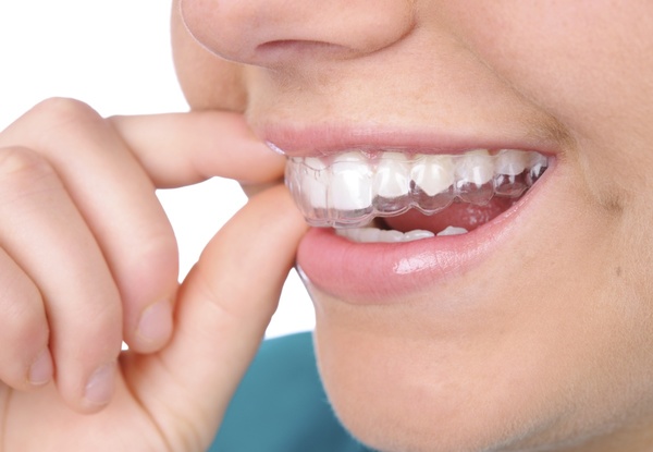 Niềng răng thưa - Phương pháp an toàn hiệu quả 4