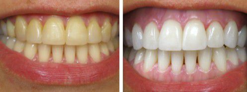 Tẩy trắng răng hết bao nhiêu tiền? 2