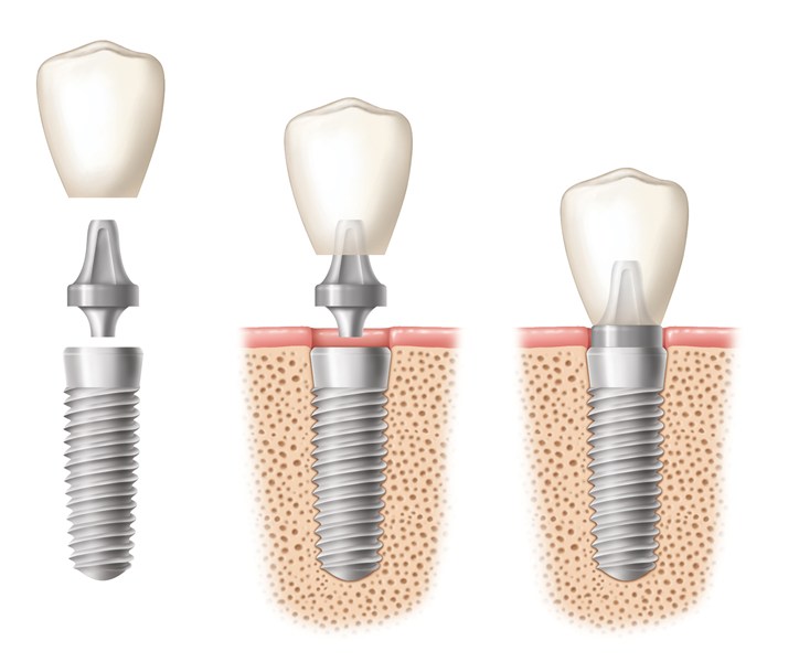 Trồng răng giả ở đâu tốt nhất tại tphcm? 1