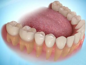 Trồng răng hàm có đau không? 1