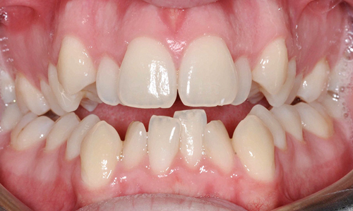 Kỹ thuật bọc răng sứ cho răng khấp khểnh 1