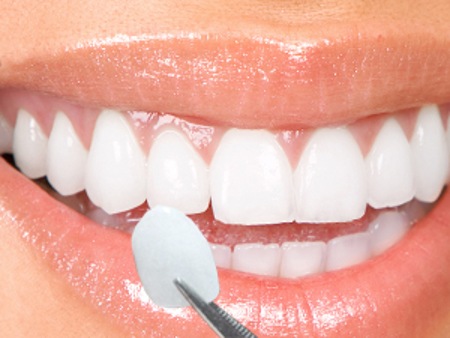 Thông tin về kỹ thuật bọc răng sứ thẩm mỹ 2