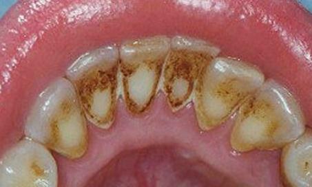 Vôi răng nhiều khi cạo vôi răng có bị chảy máu không? 1