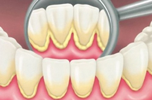 Răng bị ố vàng đi cạo vôi răng có đau không? 1