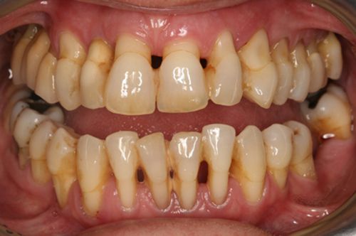 Cạo vôi răng có làm trắng răng không? 2