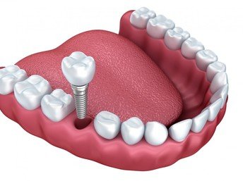 Tìm địa chỉ cấy ghép Implant ở đâu tốt? 2