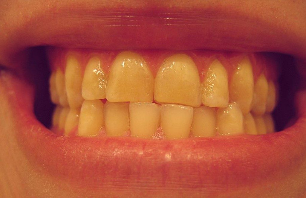 Răng yếu có nên tẩy trắng răng không? 1