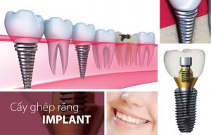 Địa chỉ trồng răng implant tốt nhất bạn đã biết đến chưa