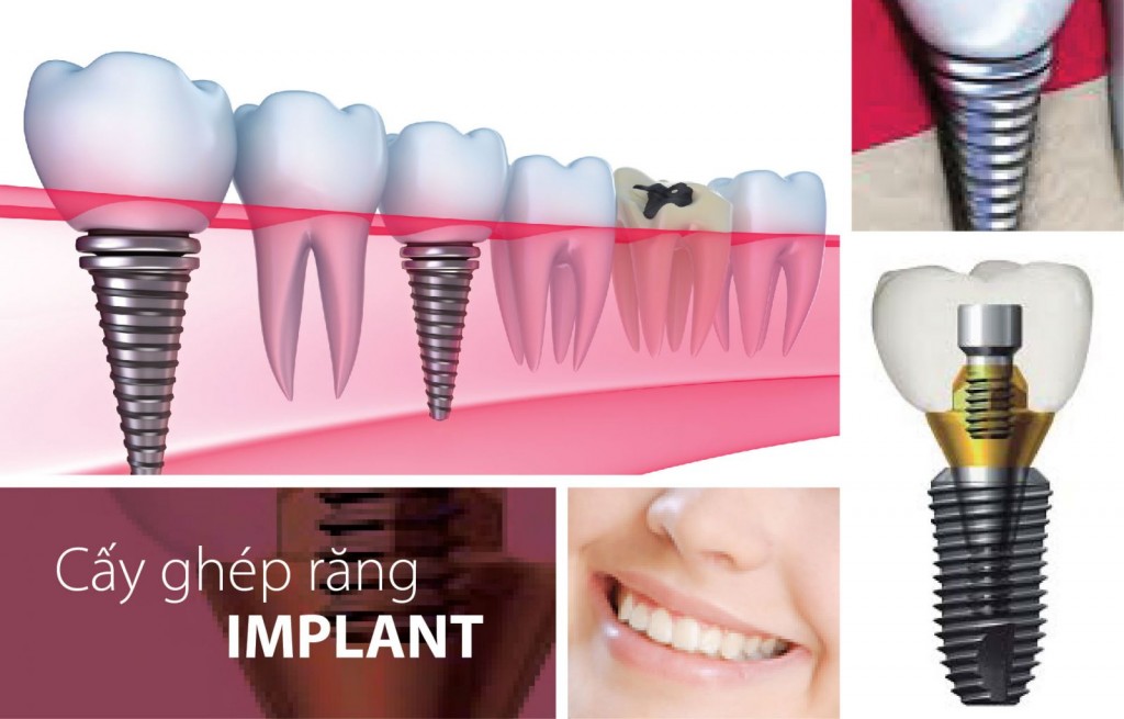 Địa chỉ trồng răng implant tốt nhất bạn đã biết đến chưa 1