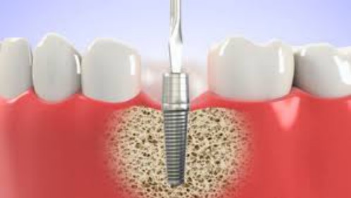Địa chỉ trồng răng implant tốt nhất bạn đã biết đến chưa 2