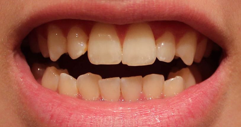 Ê buốt răng sau khi tẩy trắng do nguyên nhân gì? 1
