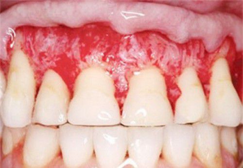 Ê buốt răng sau khi tẩy trắng do nguyên nhân gì? 3