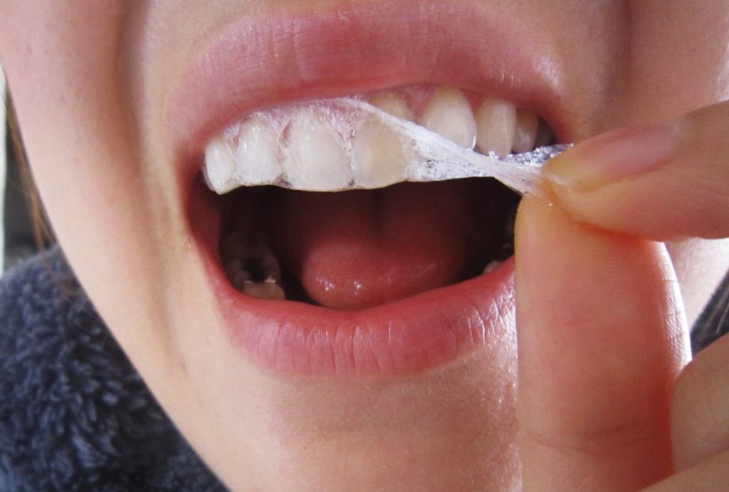 Nên tẩy trắng răng bằng phương pháp nào? 2
