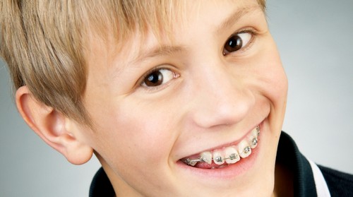 Niềng răng cho trẻ em có lợi ích gì? 2 