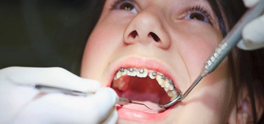 Niềng răng cho trẻ em có lợi ích gì? 3