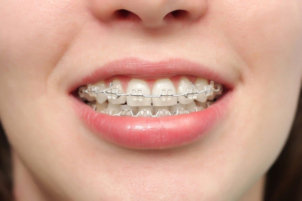 Tổng chi phí niềng răng giá bao nhiêu tiền là hoàn thành? 3