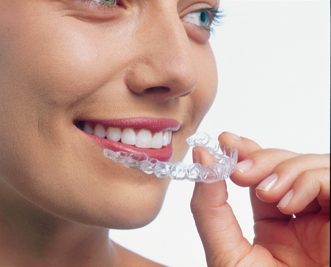 Những điều cần biết về niềng răng không mắc cài Invisalign 2