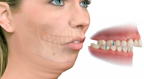 Niềng răng ở đâu tốt nhất trên ba vùng miền? 1