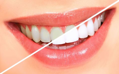 Tìm hiểu về kỹ thuật tẩy trắng răng bị nhiễm Tetracycline 3