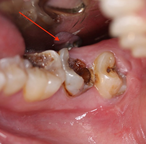 Tẩy trắng răng cho răng sâu có nên không? 1